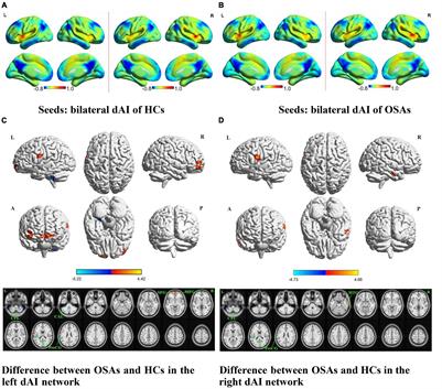 Aberrant Resting-State Functional Brain Connectivity of Insular Subregions in Obstructive Sleep Apnea